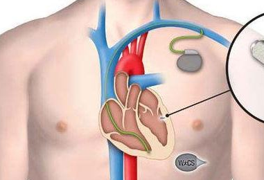 4岁女童心脏为何需要埋起搏器？