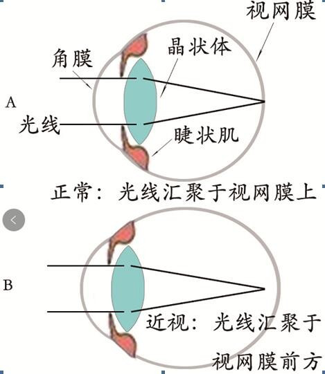 如何治疗近视