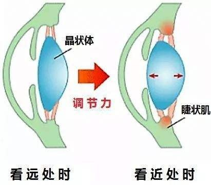 如何治疗近视