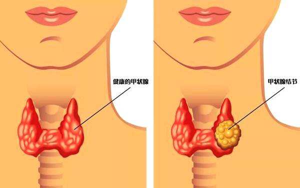 甲状腺结节