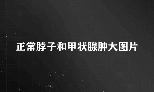 正常脖子和甲状腺肿大图片