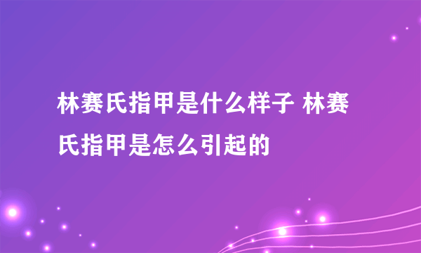 林赛氏指甲是什么样子 林赛氏指甲是怎么引起的