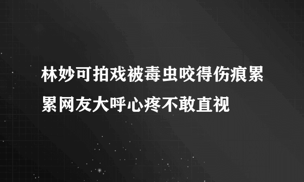 林妙可拍戏被毒虫咬得伤痕累累网友大呼心疼不敢直视