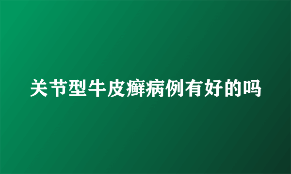 关节型牛皮癣病例有好的吗