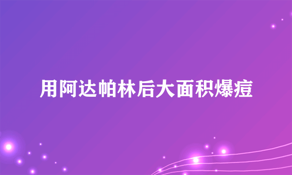 用阿达帕林后大面积爆痘