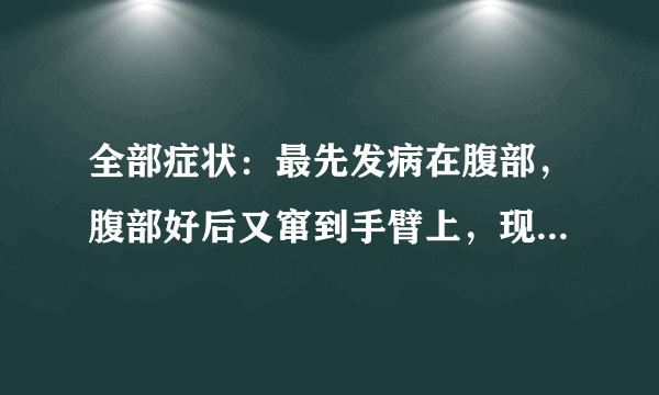 全部症状：最先发病在腹部，腹部好后又窜到手臂上，现在窜到脖子上了。发病时间及原因：87年治疗情况：吃了不少药，看了不少医生，擦了不少药，又打医生说是湿疹，有的又说是神经性皮炎，但治疗效果都不好。